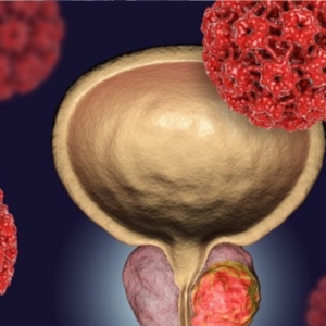 Cáncer de próstata, urología, ciudad juárez